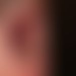 Pemphigus vulgaris: 63-year-old patient with a pemphigus vulgaris (mucocutaneous type) that has e...