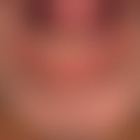 Pemphigus vulgaris: 63-year-old patient with a pemphigus vulgaris (mucocutaneous type) which has ...