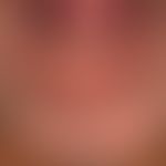 Pemphigus vulgaris: 63 Jahre alter Patient mit einem seit 3 Jahren bestehendem Pemphigus vulgaris...