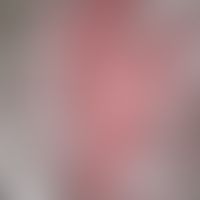 Lupus erythematodes systemischer (late onset):&nbsp;chronische, unscharf begrenzte rötlich-livide...
