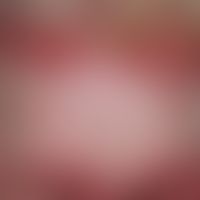 Lupus erythematodes systemischer (late onset):&nbsp;chronische, scharf und bizarr begrenzte eryth...