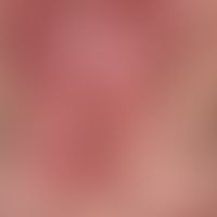 Systemic lupus erythematosus (late onset): chronic, blurred reddish-livid plaques with spatter-li...