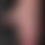 Systemic lupus erythematosus (late onset): characteristic "collagenosis hands" with variable blue...