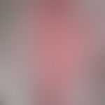 Lupus erythematosus systemic (late onset): chronic, sharply and bizarrely limited erythematous pl...