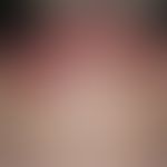 Lupus erythematosus systemic (late onset):chronic, sharply and bizarrely limited erythematous pla...