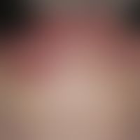 Lupus erythematosus systemic (late onset):chronic, sharply and bizarrely limited erythematous pla...