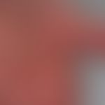 Lupus erythematosus systemic (late onset): extensive, temporarily (especially in cold weather) pa...