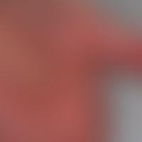 Lupus erythematosus systemic (late onset): extensive, temporarily (especially in cold weather) pa...