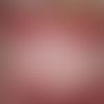 Systemic lupus erythematosus (late onset): chronic, sharply and bizarrely limited erythematous pl...