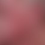 Systemic lupus erythematosus (late onset): chronic, sharply and bizarrely limited erythematous pl...