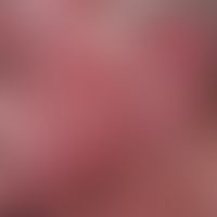 Systemic lupus erythematosus (late onset): chronic, sharply and bizarrely limited erythematous pl...