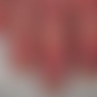Systemic lupus erythematosus (late onset): chronic, sharply and bizarrely defined livid-red plaqu...