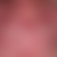 Systemic lupus erythematosus (late onset): chronic, sharply and bizarrely limited erythematous pl...