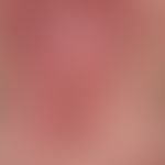 Systemic lupus erythematosus (late onset): chronic, sharply and bizarrely limited erythematous pl...
