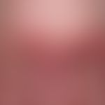 Systemic lupus erythematosus (late onset): chronic, sharply and bizarrely limited erythematous pl...