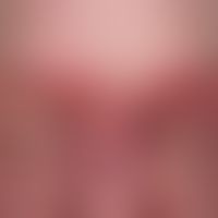 Systemic lupus erythematosus (late onset): chronic, sharply and bizarrely limited erythematous pl...