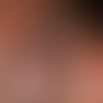 Myzetome: Indolent, chronic granulomatous infection of the skin and subcutis with circumscribed, ...