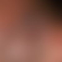 Myzetome: Indolent, chronic granulomatous infection of the skin and subcutis with circumscribed, ...