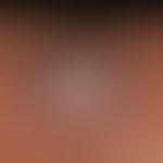 Myzetome: Sharply limited, chronic granulomatous infection of the skin and subcutis with circumsc...
