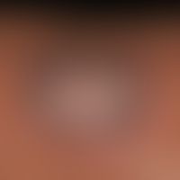 Myzetome: Sharply limited, chronic granulomatous infection of the skin and subcutis with circumsc...