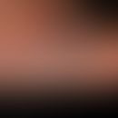 Myzetome: Indolent, chronic granulomatous infection of the skin and subcutis with circumscribed, ...