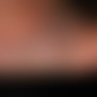 Myzetome: Indolent, chronic granulomatous infection of the skin and subcutis with circumscribed, ...