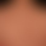 lupus erythematosus acute-cutaneous: clinical picture known for several years, occurring within 1...
