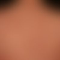 lupus erythematosus acute-cutaneous: clinical picture known for several years, occurring within 1...