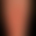 lupus erythematosus acute-cutaneous: clinical picture known for several years, occurring within 1...