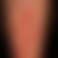 lupus erythematosus acute-cutaneous: clinical picture known for several years, occurring within 1...