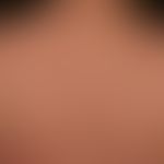 Lupus erythematosus acute-cutaneous: a clinical picture known for several years with a variable c...