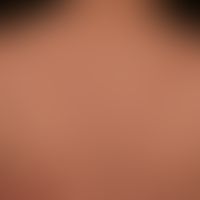 Lupus erythematosus acute-cutaneous: a clinical picture known for several years with a variable c...