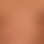 lupus erythematosus acute-cutaneous: clinical picture known for several years, occurring within 1...