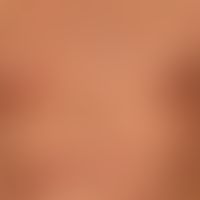 lupus erythematosus acute-cutaneous: clinical picture known for several years, occurring within 1...