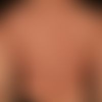 lupus erythematosus acute-cutaneous: clinical picture known for several years, occurring within 1...