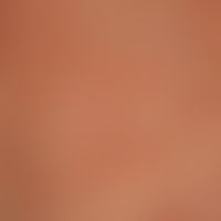 lupus erythematosus acute-cutaneous: clinical picture known for several years, occurring within 1...