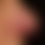 Rosacea papulo-pustulosa: persistent, intermittent plaque-like inflammation of the nose, with rec...