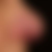 Rosacea papulo-pustulosa: persistent, intermittent plaque-like inflammation of the nose, with rec...
