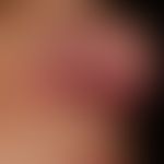 Rosacea papulo-pustulosa: persistent, intermittent plaque-like inflammation of the nose, with rec...