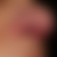 Rosacea papulo-pustulosa: persistent, intermittent plaque-like inflammation of the nose, with rec...