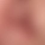Lupus erythematodes chronicus discoides:&nbsp;unscharf begrenzte, rote und braune, teils schuppen...