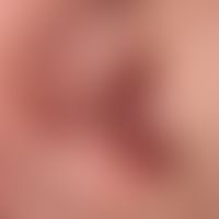 Lupus erythematodes chronicus discoides:&nbsp;unscharf begrenzte, rote und braune, teils schuppen...