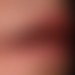 Chronische Cheilitis bei Lupus erythematodes chronicus discoides: chronisch aktive, rote, hyperäs...
