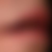 Chronische Cheilitis bei Lupus erythematodes chronicus discoides: chronisch aktive, rote, hyperäs...