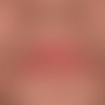 Chronische Cheilitis bei Lupus erythematodes chronicus discoides. Chronisch aktive, rote, hyperäs...