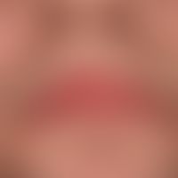 Chronische Cheilitis bei Lupus erythematodes chronicus discoides. Chronisch aktive, rote, hyperäs...