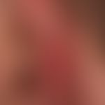 Lupus erythematodes chronicus discoides:&nbsp;unscharf begrenzte, rote und braune, teils schuppen...