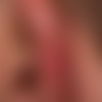 Lupus erythematodes chronicus discoides:&nbsp;unscharf begrenzte, rote und braune, teils schuppen...