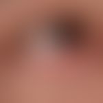 Chronische (vernarbende) Blepharitis bei Lupus erythematodes chronicus discoides: chronisch aktiv...