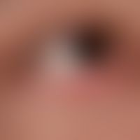 Chronische (vernarbende) Blepharitis bei Lupus erythematodes chronicus discoides: chronisch aktiv...